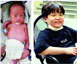 미숙아(왼쪽)로 태어나 9살 생일 맞은 이하람(오른쪽)군. 이진영씨 제공