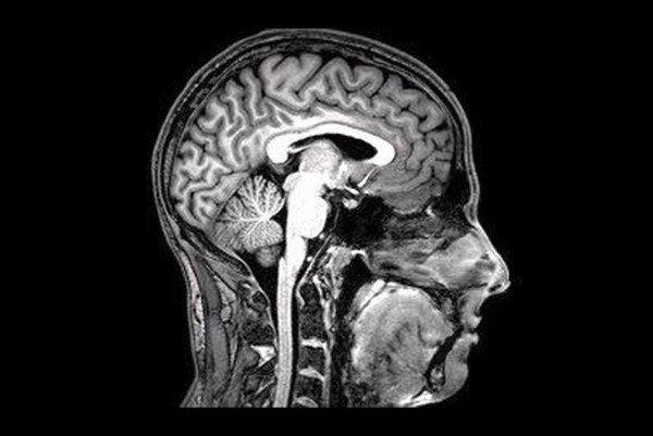 미국 매서추세츠공대(MIT)를 중심으로 한 미국과 캐나다 공동연구진이 뇌 촬영 사진에서 주목한 부분은 중뇌에 있는 흑질(substantia nigra)이라는 영역이다. 흑질은 보상과 관련한 반응을 일으키는 신경전달물질 도파민을 분비하는 뇌 영역이다.   뇌의 MRI 촬영 사진. 위키미디어 코먼스.   출처: 한겨레, 2020-12-02.
