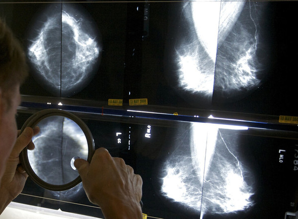 미국 로스앤젤레스의 한 방사선 전문의가 유방암 진단을 위해 엑스선 사진을 돋보기로 들여다 보고 있다. 로스앤젤레스/AP 연합뉴스. 한겨레, 2024.2.2.